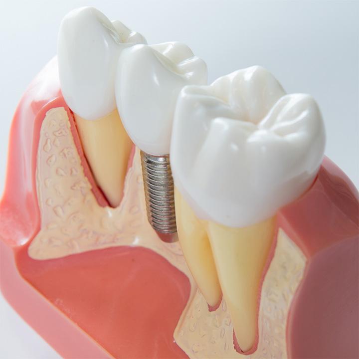 dentiste-chablais-article-implant-dentaire-04