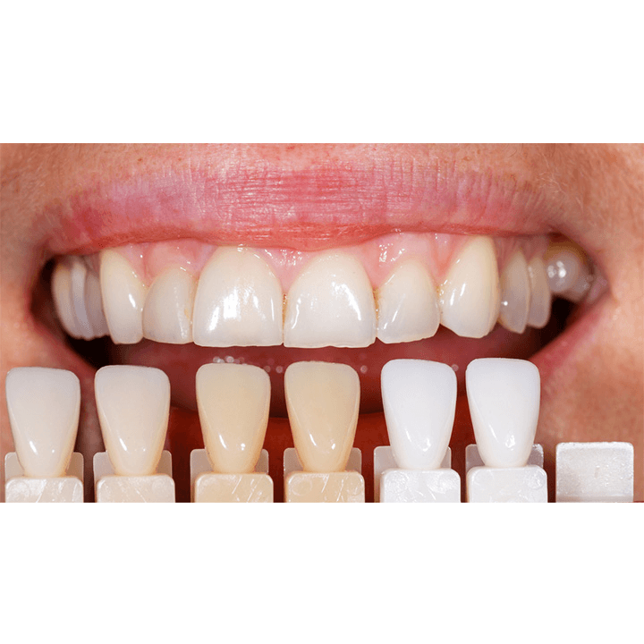 dentiste-chablais-article-implant-dentaire-06