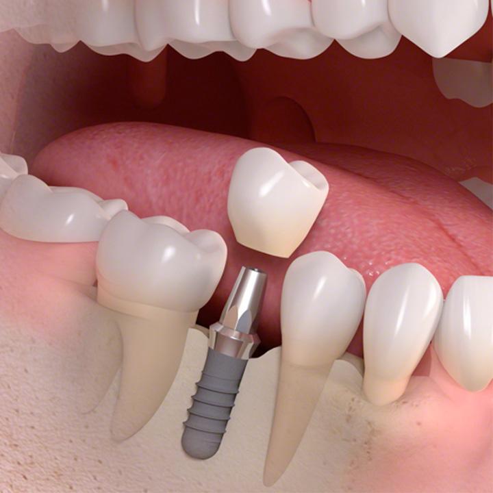 dentiste-chablais-article-implant-dentaire-07